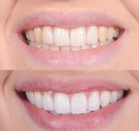 Clareador Dental Viya White - (50% DE DESCONTO)