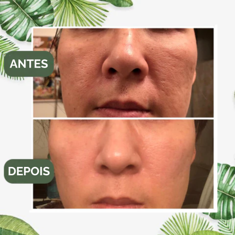Máscara de Chá Verde  Limpeza Profunda Cravos e Espinhas